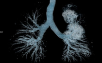 上海世界医药合同定制服务展 ICSE China，CPHI 2025制药原料展简讯药物能否推动支气管扩张疗法