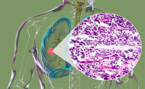 上海世界医药包装展览会 InnoPack China，PMEC药机展快讯 创新方法改善癌症免疫治疗