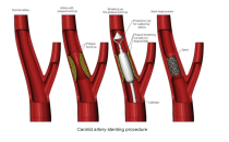 2026上海医疗器械展览会|血管介入医疗器械行业市场分析报告（颈动脉支架篇）